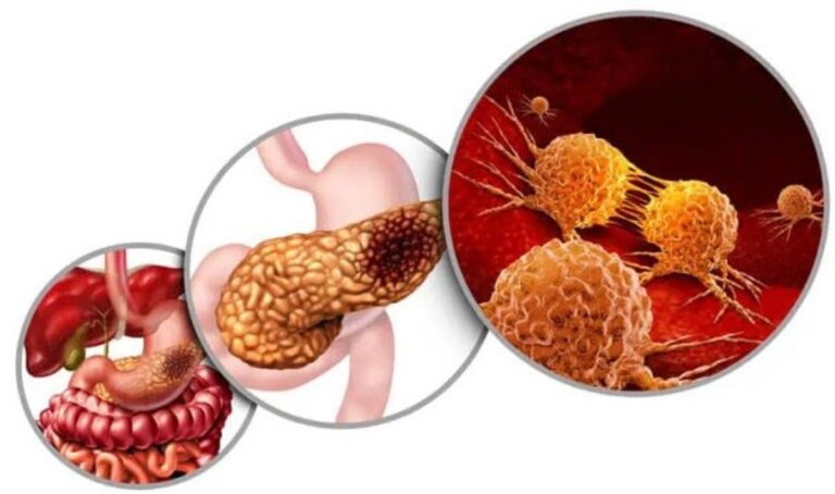 Diseñan un nuevo fármaco para combatir el cáncer de páncreas con inhibidores duales